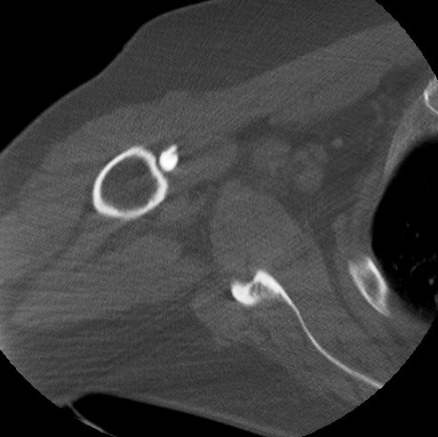 Figure 4 for case Supraspinatus and biceps tendon tears ( RID1953 )( RID1944 )